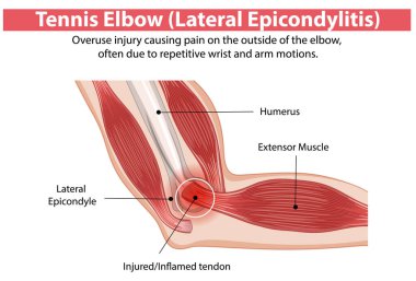 Illustration of tennis elbow injury and affected areas clipart