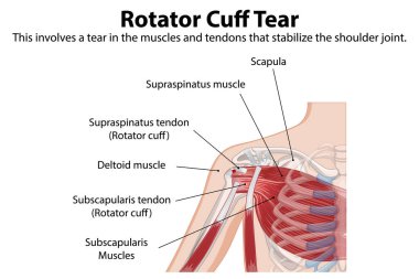 Omuz kası yırtılmasının detaylı anatomisi