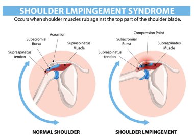 Comparison of normal shoulder and shoulder impingement clipart