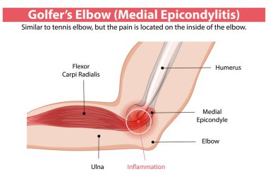 Detailed diagram of medial epicondylitis in the elbow clipart