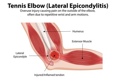 Detailed diagram of tennis elbow condition clipart