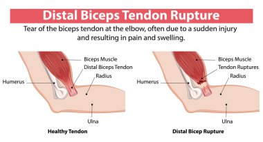 Comparison of healthy and ruptured biceps tendon clipart