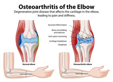 Normal ve osteoartritik dirsek eklemlerinin karşılaştırılması