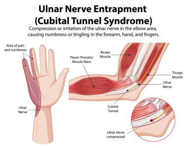 Kübital tünel sendromunun ayrıntılı diyagramı