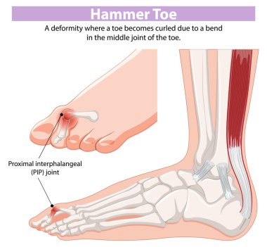 Diagram showing hammer toe deformity and PIP joint clipart
