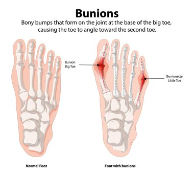 Comparison of normal foot and foot with bunions clipart