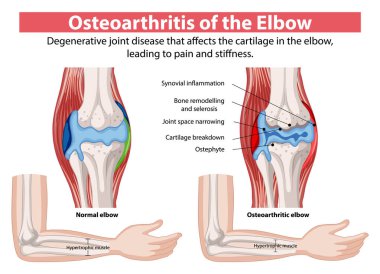 Dejeneratif eklem hastalığı ağrıya ve sertliğe neden olur.