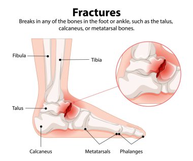 Illustration of fractures in foot and ankle bones clipart