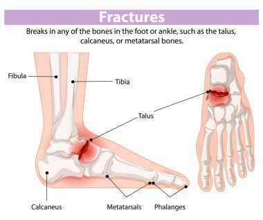 Illustration of foot and ankle bone fractures clipart