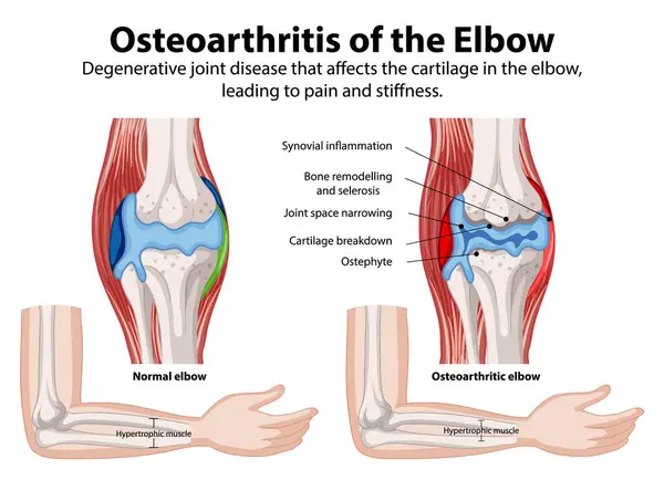 stock vector Comparison of normal and osteoarthritic elbow joints