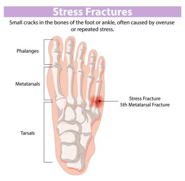 Diagram showing stress fractures in foot bones clipart