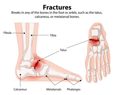 Illustration of foot and ankle bone fractures clipart