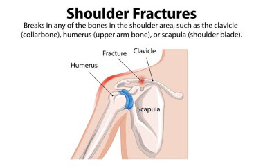 Diagram of shoulder fractures and affected bones clipart