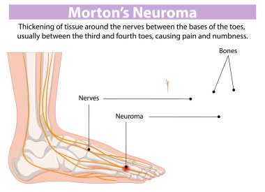 Ayağındaki sinir ve nöromayı gösteren diyagram.