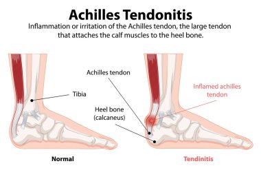 Comparison of normal and inflamed Achilles tendon clipart