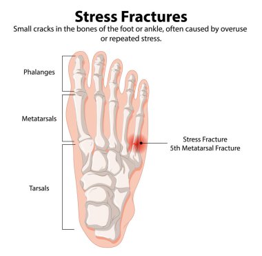 Illustration of foot bones with stress fracture clipart