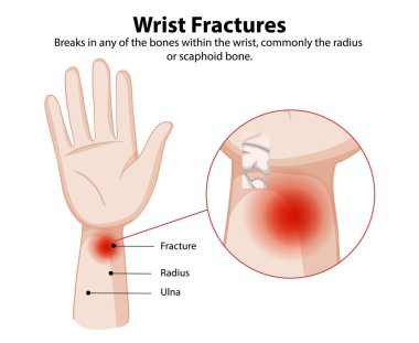 Bilek kırıkları ve etkilenmiş kemikler.