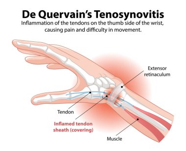 Bileğinde iltihaplı tendon kılıfı var.