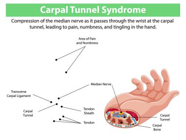 Detailed diagram of carpal tunnel syndrome symptoms clipart