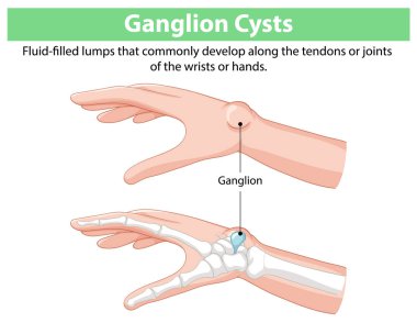El ve bileklerdeki ganglion kistlerinin resmi