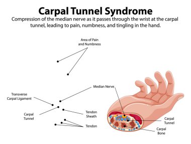 Karpal tünel sendromu belirtilerinin ayrıntılı diyagramı