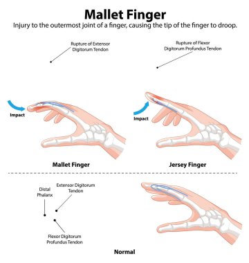 Parmak tendonu yaralanmaları ve normal anatomi