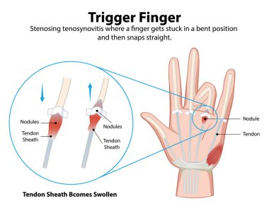 Diagram explaining trigger finger condition clipart