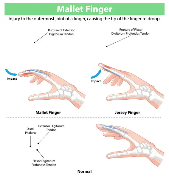 Stock vector Diagram showing mallet and jersey finger injuries