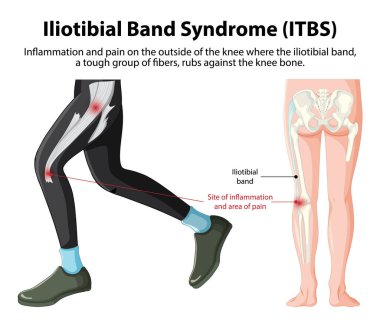 ITBS ağrısı ve dizinde iltihap var.