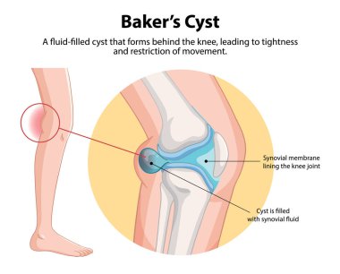 Fluid-filled cyst causing knee tightness clipart
