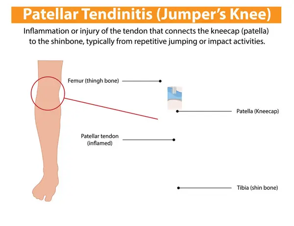 stock vector Inflammation of the patellar tendon from repetitive jumping