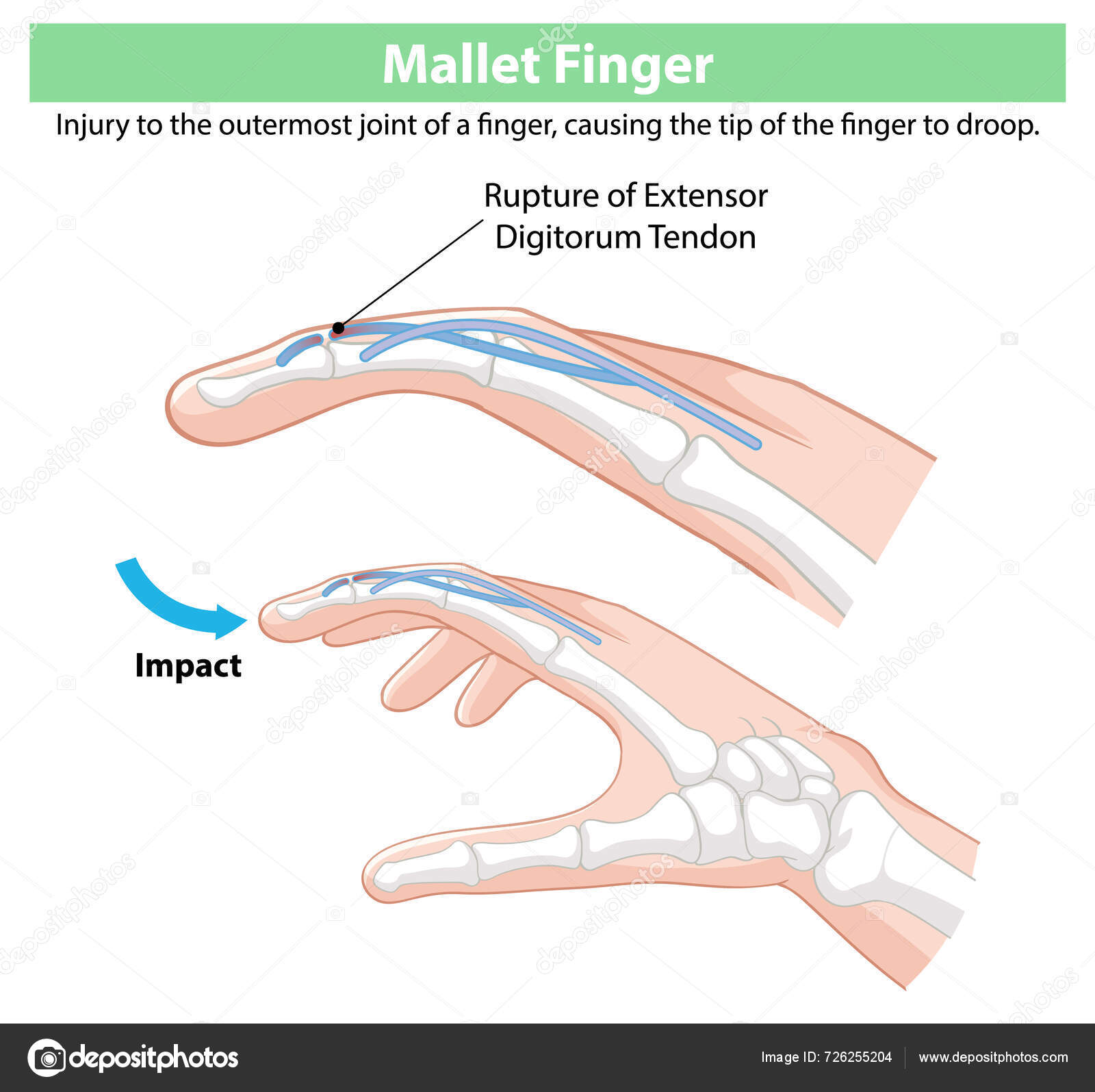 Diagram Showing Mallet Finger Injury Tendon Rupture Stock Vector by ...