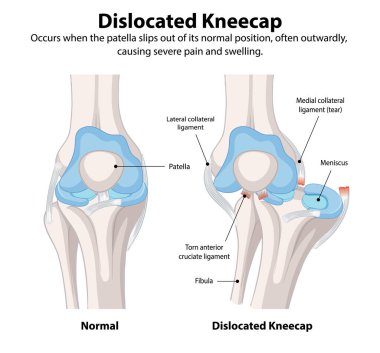Comparison of normal and dislocated kneecap clipart
