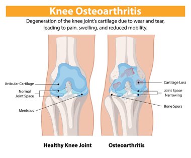 Sağlıklı diz eklemleri, osteoartritten etkilenmiş dizlere karşı.