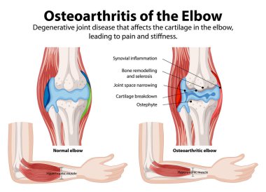 Normal ve osteoartritik dirsek eklemlerinin karşılaştırılması