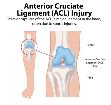 ACL 'in dizdeki yırtılma görüntüsü