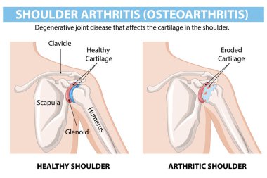 Illustration of healthy and arthritic shoulder joints clipart