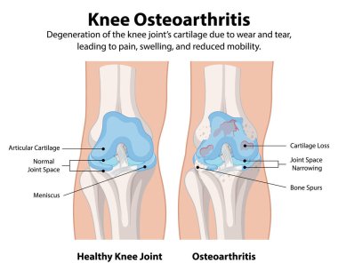 Sağlıklı diz eklemi osteoartrit diz eklemine karşı.
