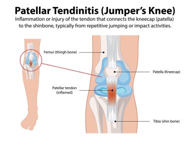 Diagram explaining jumper's knee condition clipart