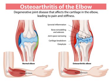 Normal ve osteoartritik dirsek eklemlerinin karşılaştırılması