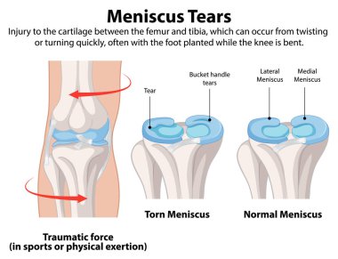 Illustration of torn and normal meniscus in knee clipart