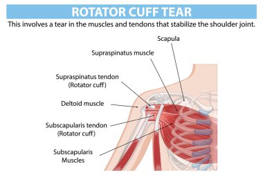 Omuz döndürme yırtığının detaylı anatomisi