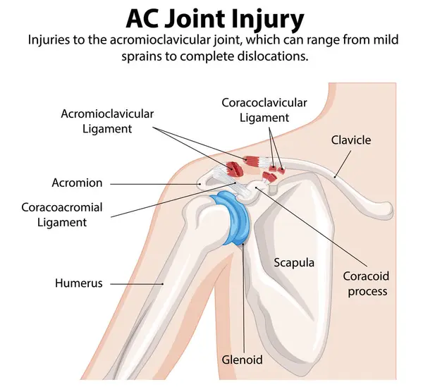 stock vector Detailed illustration of shoulder joint injury