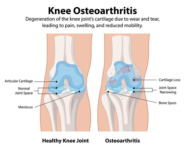 Healthy knee joint vs osteoarthritis knee joint