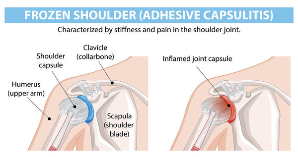 Диаграмма с замороженным состоянием плеч и анатомией