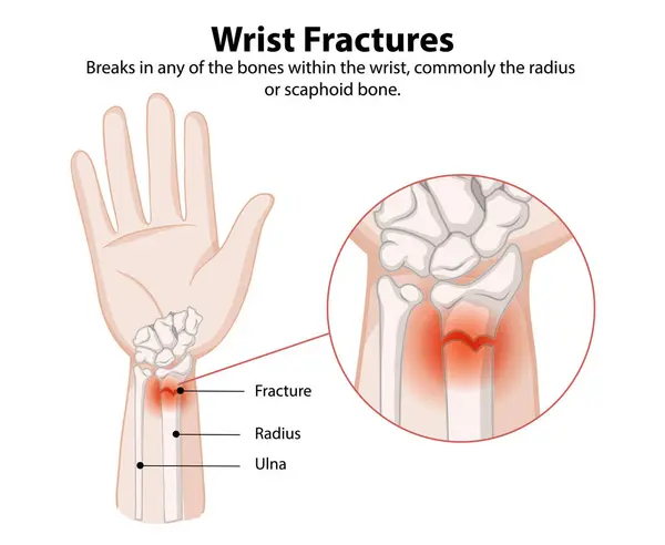 stock vector Illustration of wrist fractures and affected bones
