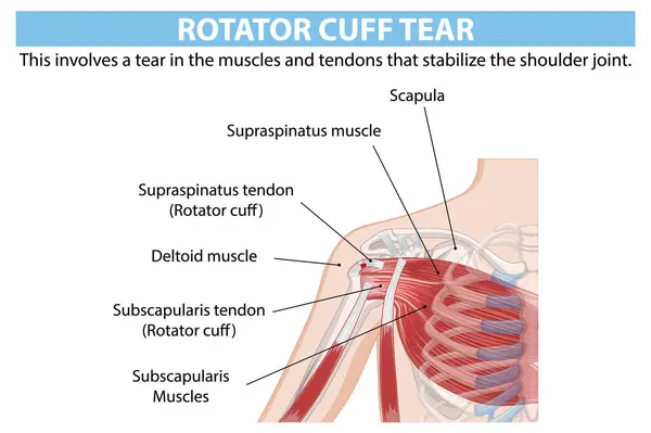 stock vector Detailed anatomy of shoulder rotator cuff tear