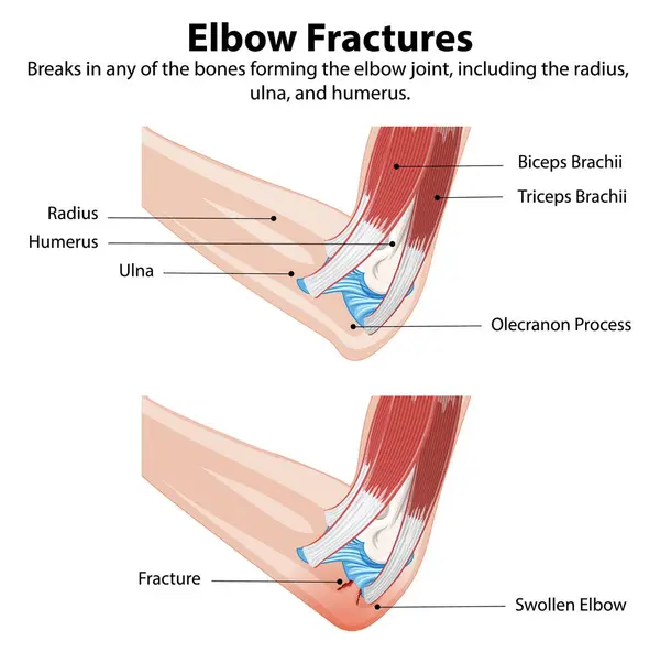 stock vector Diagram showing types of elbow fractures