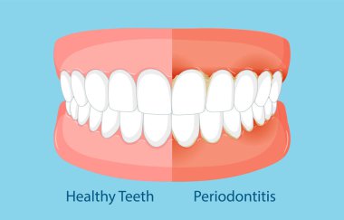 Sağlıklı dişler ve periodontit etkilerini gösteren çizimler