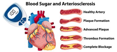 Arter sağlığı aşamaları ve kalp anatomisini gösteren diyagram